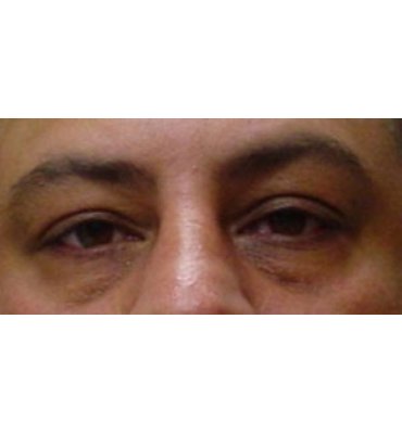 Facelift & Facial Skin Rejuvenation Before